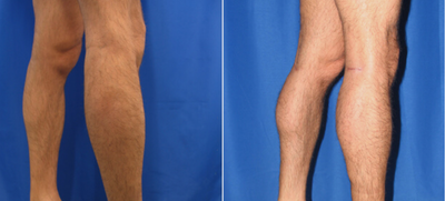 Man treated with Calf Implant - Man treated with Calf Implant