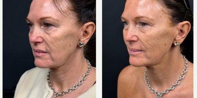45-54 year old woman treated with Endolift, Nonsurgical Facelift - Turkey neck, crepey neck skin, neck horizontal lines, laxity under chin, marionettes, early jowling.