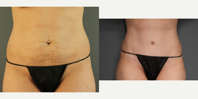 35-44 year old woman treated with Drainless Tummy Tuck - Patient is a 38 year old mother of 4 who was bothered by abdominal diastasis and excess skin. I performed a tummy tuck with lateral suctioning and used TissuGlu to eliminate the need for drains.