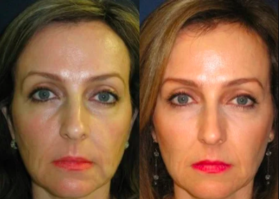 Sculptra - 	Treated a patient with Sculptra to restore volume to her face.