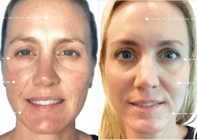 35-44 year old woman treated with VI Peel - Botox and Vi Peel Treatment Together