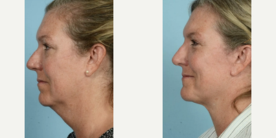 Woman treated with Rhinoplasty, Eyelid Surgery - Woman treated with Rhinoplasty, Eyelid Surgery