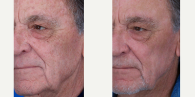 65-74 year old man treated with Chemical Peel, Pico Genesis - 76-year-old male with multiple actinic keratosis and lentigines to face. He was treated with a TCA chemical peel and picosecond laser.
