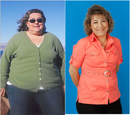 Female Gastric Bypass Patient Lost 175 lb - 
	This female patient lost 175 pounds in just 9 months after her gastric bypass procedure.
