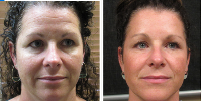 45-54 year old woman treated with BroadBand Light (BBL) - Nu-Bright PackageOur Nu-Bright package is the perfect starting point for anyone looking to address skin discoloration and moderate wrinkles. Specifically designed to target sun spots, redness, blotches, freckles, as well as common concerns like 11 lines, crows feet, bunny lines on the nose, and even faded lips, this package offers a comprehensive solution for a refreshed appearance.Whats Included:Two Sessions of BBL (BroadBand Light): These sessions work to correct pigmentation issues, reduce redness, and even out your skin tone, giving you a brighter, more uniform complexion.One Session of Botox/Dysport: This treatment smooths out moderate wrinkles, such as the lines between your brows, around your eyes, and on your nose, for a more youthful and relaxed look.Benefits:No Downtime: You can return to your daily activities immediately after each session, making this package convenient for those with busy schedules.The Nu-Bright package offers a targeted, effective approach to revitalizing your skin and smoothing out wrinkles, helping you achieve a naturally radiant and youthful appearance without the need for invasive procedures.