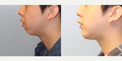 25-34 year old man treated with Chin Implant - Chin implant placed by Dr. Bryson Richards