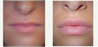 25-34 year old woman treated with Juvederm - Beautiful results with Juvederm to the lips in just 2 months