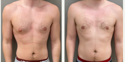26 year old man treated with Gynecomastia Surgery - 26 yo s/p male breast reduction performed under local anesthesia with sedation performed in our on site AAAA certified operating suite.