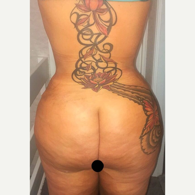 35-44 year old woman treated with Brazilian Butt Lift - BBL