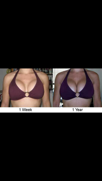 Breast augmentation 32A to 34DD - Review - RealSelf