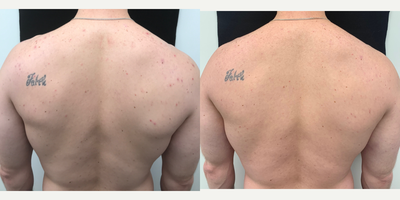 25-34 year old man treated with Acne Treatment - Back acne treated with one PCA body peel. Cleared up inflammation and reduced breakouts within 2 weeks.