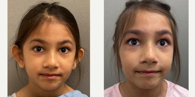 7 year old girl treated with otoplasty (ear pinning) - 7 yo s/p otoplasty performed under local anesthesia in our on site AAAA certified operating suite.
