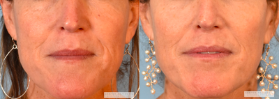 54 year old female treated with Excel V - 2 Months Post Treatment - 1 Treatment of Excel-V to Nose & Cheeks for Redness