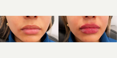 Woman treated with Juvederm - Woman treated with 1ml of Juvederm XC as lip fillers
