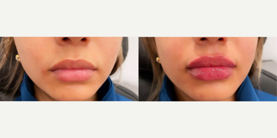 Woman treated with Lip Fillers - Woman treated with Lip Fillers using 1ml of Juvederm XC