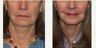 55-64 year old woman treated with Facial Fat Transfer, Restylane, Nonsurgical Facelift - Patient had a Mid Face Fat Transfer from abdomen to bilateral cheeks and bilateral Marionette lines. She also had Restylane filler to her perioral area.
