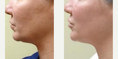 Woman treated with Laser Genesis - Woman treated with Laser Genesis