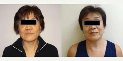 Woman treated with Laser Genesis - Woman treated with Laser Genesis