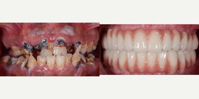 45-54 year old man treated with Dental Bone Graft - 6 Straumann Implant Procedure in Upper and Lower Jaw, Hybrid Acrylic Prosthesis in Both Jaws, 9 Canal Treatment with Fiber Post, Full Tooth Extractions and Full mouth Zirconium Crowns.