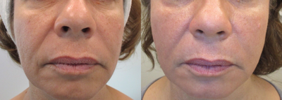 55-64 year old woman treated with Titan - 3 Treatments of Titan XL to tighten aging skin