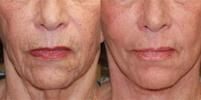 75 and up year old woman treated with Fractional Laser and face and neck lift - She was not happy with her sagging neck and jowls and the lines on her face, especially the lines around the mouth and brown spots. She underwent a face and neck lift with a fractionated CO2 laser around her mouth.&nbsp;