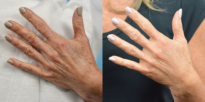 Woman treated with Hand Rejuvenation, Radiesse - Dr. James Marotta was able to refresh and rejuvenate aging hands with Radiesse.