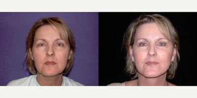 Woman treated with Facelift - ACE LIFTS. Are you looking to have a refreshed, balanced and natural look? A facelift could be youranswer! By making overall improvements to the jawline and neckline you can get a moreyouthful appearance. Learn more about specific facelift procedures. Schedule a private consultation today with a board certified plastic surgeon.