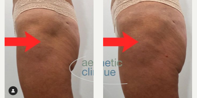 Woman treated with Renuva - Woman treated with Dermal Fillers, Renuva