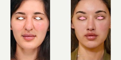 25-34 year old woman treated with Facelift, Rhinoplasty, Lip Lift, Facial Fat Transfer, Brow Lift - Young woman who underwent an endoscopic mid-face lift, rotational endoscopic brow lift, lip lift, fat transfer and rhinoplasty