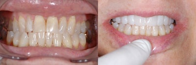 Lumineers Dental Veneers - 
	Patient was interested in having teeth that are visible when smiling more aesthetic. Lumineers prepless veneers fit her time well and she was thrilled with the results.
