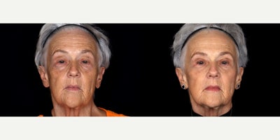 72 year old woman treated with 3 syringes of Bellafill to cheeks and under eye - 72 year old woman treated with 3 syringes of Bellafill to cheeks and under eye. Photos depict before and 3 months after treatment.