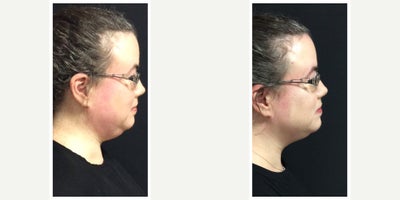 35-44 year old woman treated with CoolMini - CoolMini on the chin