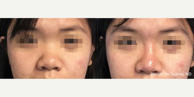 18-24 year old woman treated with Non Surgical Nose Job - Nasal augmentation with Restylane Lyft