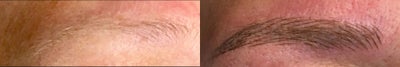 65-74 year old woman treated with Microblading - The patients eyebrows were thinning and the hairs were very light in color. She desired a natural looking eyebrow.
