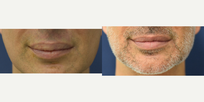 45-54 year old man treated with Lip Reduction - Botched and repaired. Before and after photo 1 week after upper lip implant removal