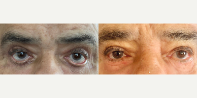 Man treated with Eyelid Surgery, Eyelid Retraction Repair - Lower eyelid retraction and ectropion are often observed as complications following lower eyelid blepharoplasty when the surgery is not individually tailored.These complications are not only cosmetic concerns but can also cause severe corneal problems that may lead to blindness.