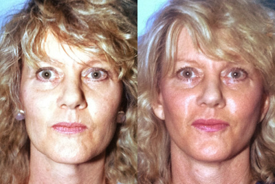 This Woman received a Face Lift - This Woman received a Face Lift.