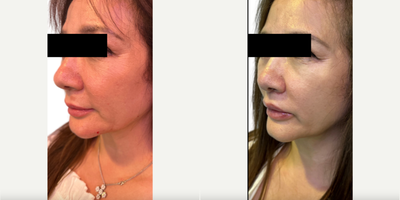 Woman treated with Dermal Fillers, Lip Fillers, Chin Filler - Woman treated with Chin Filler