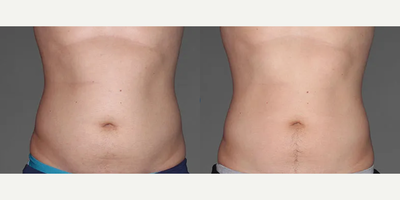 Man treated with CoolTone - Man treated with CoolTone