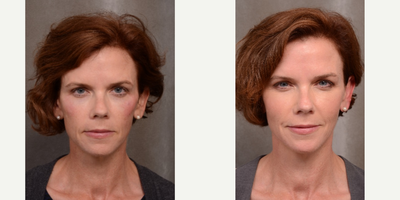 45-54 year old woman treated with Voluma for Cheek Augmentation - 53 year old woman is shown one week after treatment with Juvederm VOLUMA.  She was treated for fat loss and relative hollowing in the temples and cheeks.