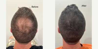 35-44 year old man treated with Scalp Micropigmentation - 44 year old male 4 months after SMP.
