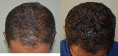 25-34 year old man treated with Derma Roller - 28 years old male patient complaints of androgenetic alopecia. 6 sessions of derma roller done for scalp.