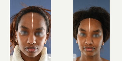 18-24 year old woman treated with Forehead Reduction, Facial Feminization Surgery - Hairline lowering to reduce forehead height and create a softer, more harmonious frame to the face. The patient also had a prominent forehead/brow bone, which was reduced with forehead shaving to smooth the contour and improve overall balance.Photos show the result after healing; individual results and recovery times may vary.