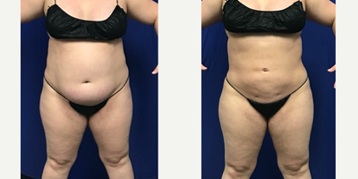 25-34 year old woman treated with Tickle Lipo, Renuvion - 32 year old female patient had 4125ml of fat removed via Tickle Lipo from her: Upper/lower AbdomenFlanksHipsAlong with Renuvion skin tightening to her abdomen.