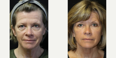 Vampire Facial - Microneedleing + PRP