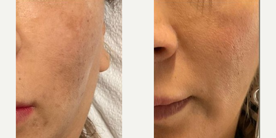 Woman treated with Aquagold - Woman treated with PRP Injections, Aquagold