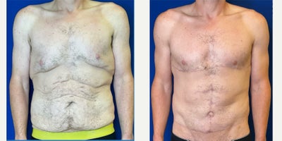 35-44 year old man treated with Gynecomastia Surgery, Nipple Surgery, Tummy Tuck, Liposuction - This patient in his late 30s made a powerful commitment to changeembracing a healthier lifestyle, achieving significant weight loss, and staying dedicated to a consistent exercise regimen.After doing the hard work, he chose to complete his journey with gynecomastia correction using free nipple grafts and a fleur-de-lis abdominoplasty to remove excess skin and restore a stronger, more confident contour.