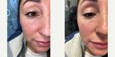 35-44 year old woman treated with Volbella - This is directly after PA Steve used Juvederm Volbella XC in the under-eye to improve dark circles and overall hollow, tired eyes.