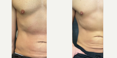 25-34 year old man treated with Laser Hair Removal - If you are a male who is tired of the hassle of waxing and shaving, it may be time to consider laser hair removal. This innovative treatment offers a more permanent solution to unwanted hair, allowing you to enjoy smooth, hair-free skin for longer periods of time. With the advancements in technology, laser hair removal has become a safe and effective option for men looking to eliminate hair from various parts of their body. One notable provider in this field is Rarev Medspa, located in Las Vegas. Rarev Medspa offers top-of-the-line laser hair removal services, ensuring that clients receive the best possible results. So, if you are tired of dealing with constant grooming, consider laser hair removal at Rarev Medspa in Las Vegas.