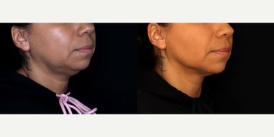 41 year old woman treated with Liposuction, PrecisionTx - 41 year old female treated with submental liposuction (Precision tx) Photos depict before and 6 months after surgery